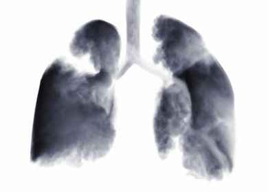 cancro polmone