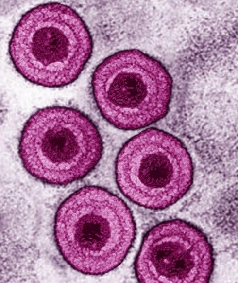 virus varicella