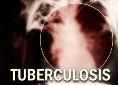 tubercolosi