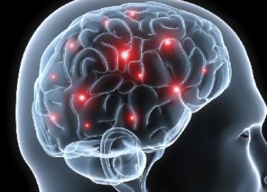 alzheimer