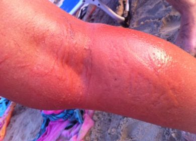 vescica su gamba colpita da medusa