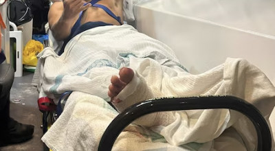 Un surfista uruguaiano di 20 anni sopravvive all'attacco di uno squalo in Australia grazie ai riflessi pronti
