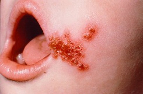 impetigine impetigine