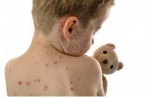 morbillo morbillo