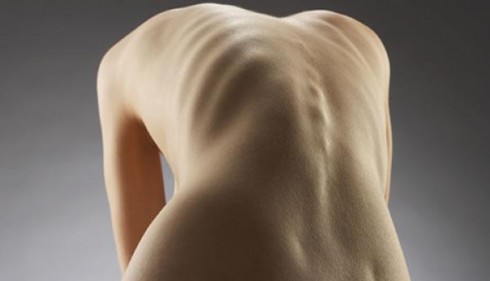anoressia anoressia