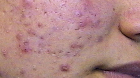 Allarme farmaco anti acne induce suicidio?