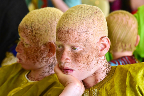 Albinismo: giornata internazionale di sensibilizzazione a Dakar