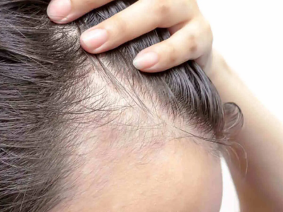 Stati Uniti, la FDA approva la prima pillola per l'alopecia