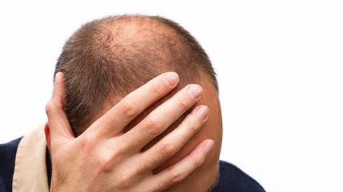 Farmaci, Aifa e FOFI: rischi di disfunzione sessuale e disordini psichiatrici con medicinali contenenti finasteride indicati per il trattamento dell'alopecia androgenetica