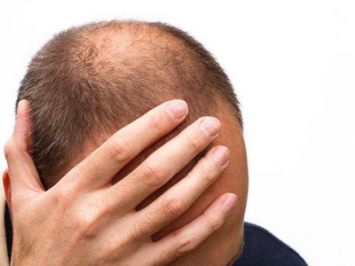 Farmaci, Aifa e FOFI: rischi di disfunzione sessuale e disordini psichiatrici con medicinali contenenti finasteride indicati per il trattamento dell'alopecia androgenetica