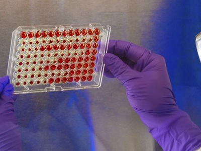 Covid "preoccupante" cosa può fare al sangue