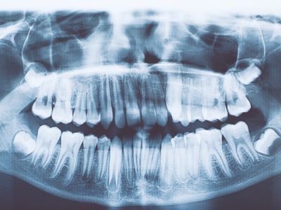 Dentisti estraggono oltre 500 denti dalla bocca di un bambino di 7 anni