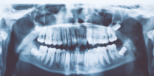 Dentisti estraggono oltre 500 denti dalla bocca di un bambino di 7 anni