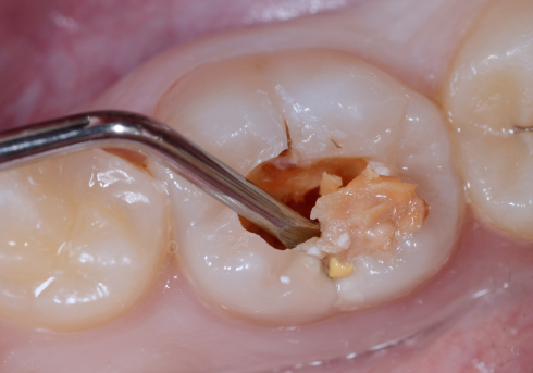 Svolta nella lotta contro la carie: i ricercatori sviluppano un gel miracoloso per i denti. Test superati