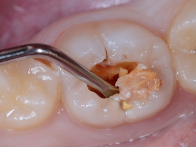 Svolta nella lotta contro la carie: i ricercatori sviluppano un gel miracoloso per i denti. Test superati