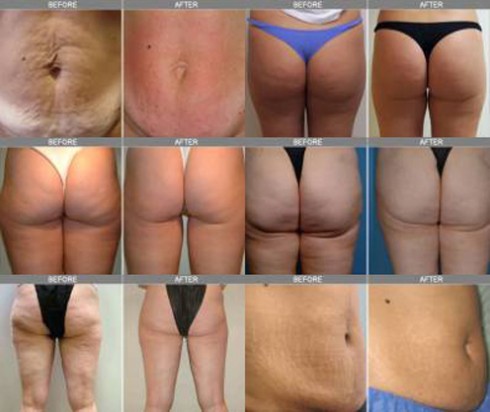 cellulite cellulite