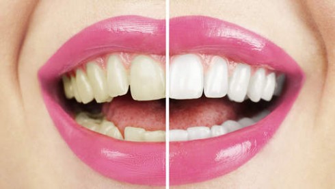 denti sbiancamento denti sbiancamento