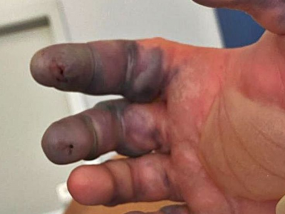 Un giovane turista perde due dita della mano dopo il morso di un ragno a Ibiza.