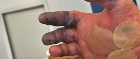 Un giovane turista perde due dita della mano dopo il morso di un ragno a Ibiza.