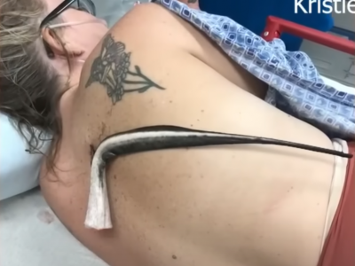 Donna della Florida trafitta da una razza, polmone mancato per pochi centimetri