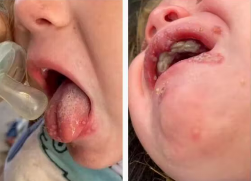 La bambina di un anno si ammala gravemente dopo essere stata baciata in bocca