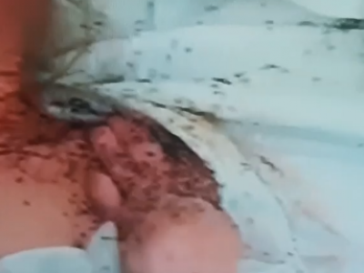 Portogallo sotto shock per il caso di un’anziana allettata ricoperta di formiche in una casa di riposo