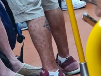 L'uomo di Monkeypox viaggia in metropolitana: la foto diventa virale