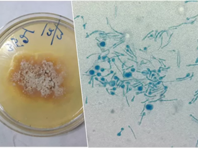 Un fungo “vegetale” infetta per la prima volta un essere umano: “Una scoperta allarmante”