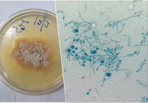 Un fungo “vegetale” infetta per la prima volta un essere umano: “Una scoperta allarmante”