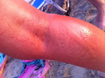 vescica su gamba colpita da medusa