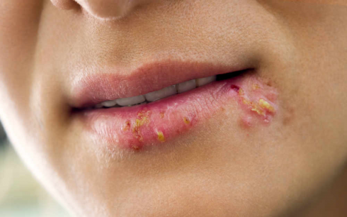 Farmaco antivirale per la Cura dell'Herpes Simplex ritirato volontariamente dalle farmacie.