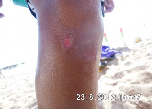 infezione impetigine infezione impetigine