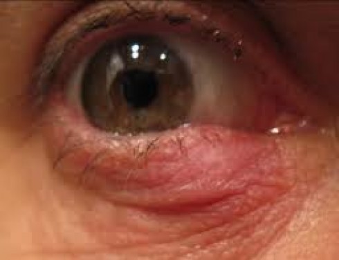 infezione oculare infezione oculare