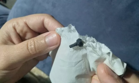 Lego bloccato nel naso del bambino finisce per cadere due anni dopo.