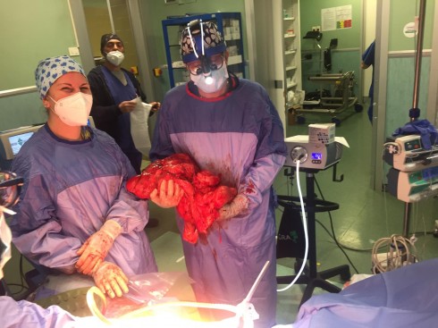 Asportato tumore raro di oltre 13 kg al “Fazzi” di Lecce. Nessuna trasfusione: la paziente è testimone di Geova