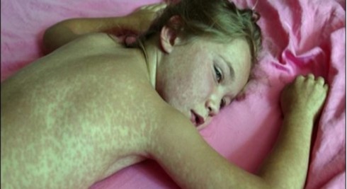 morbillo morbillo