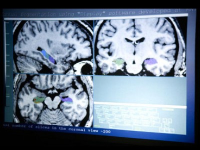 neuroimmaging