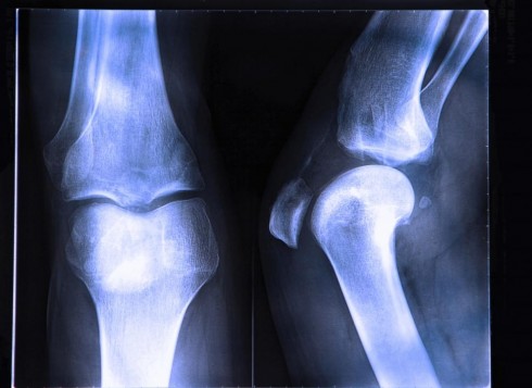 radiografie delle ossa radiografie delle ossa