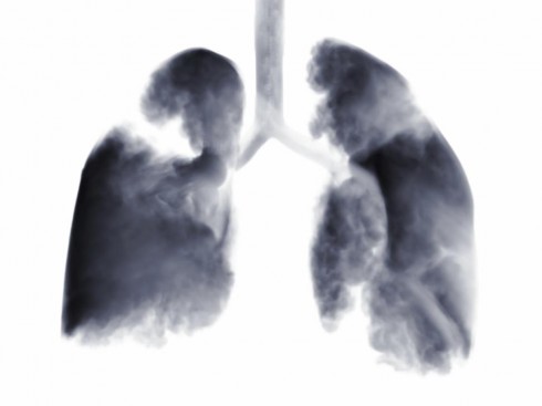 cancro polmone cancro polmone