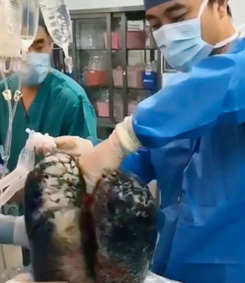 Il medico condivide su YouTube immagini scioccanti dei polmoni di un fumatore.