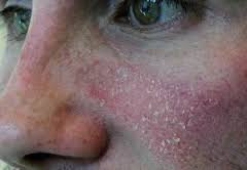 dermatosi dermatosi