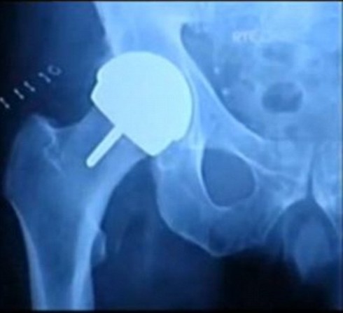 protesi metalliche dell'anca
