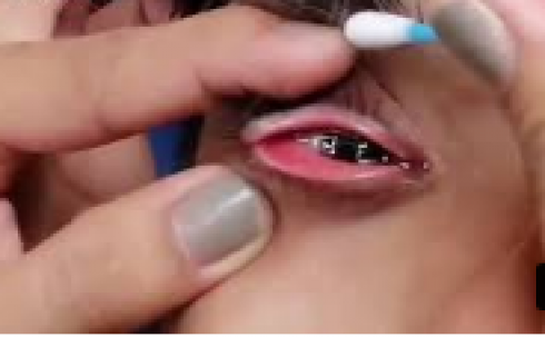 Due sanguisughe di 3 cm estratte dagli occhi di un ragazzo - VIDEO