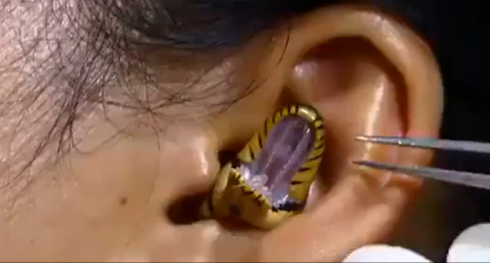 Il "chirurgo" tenta di rimuovere il serpente vivo dall'orecchio della donna – VIDEO