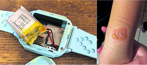 Tecnologia "esplosiva". Svizzera: smartwatch cinese ustiona il polso di un bambino.