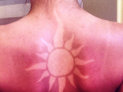 Tatuaggi bruciati dal sole: riappare sui social una moda pericolosa