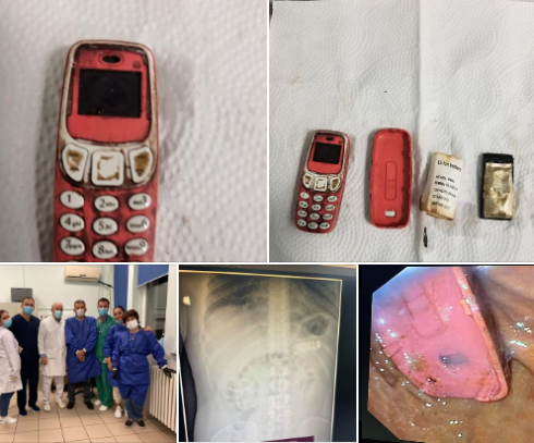 L'origine dei suoi dolori di stomaco era ... un Nokia 3310 – VIDEO-
