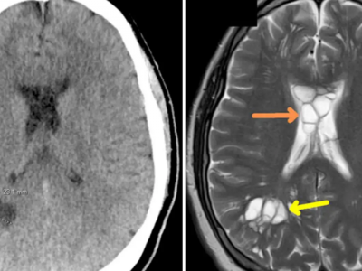 Tenia solium: ingerisce mentre mangia salumi il verme solitario scoperto a causa delle frequenti emicranie