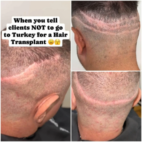 Un medico americano ha condiviso un video di pazienti che si sono recati in Turchia per un trapianto di capelli e sono tornati sfigurati