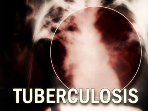 tubercolosi